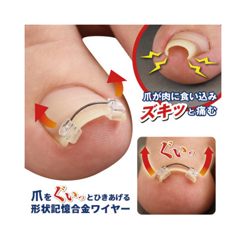 巻き爪ワイヤーガード